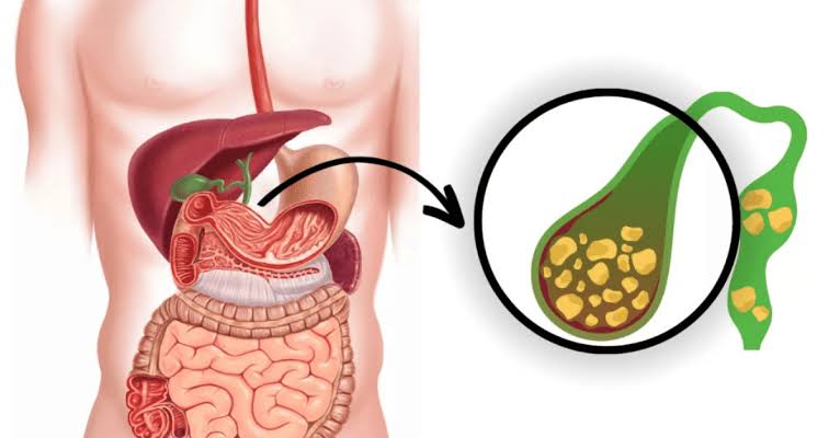 Gallbladder Stone ହେବାର ଲକ୍ଷଣ, କାରଣ, ଚିକିତ୍ସା