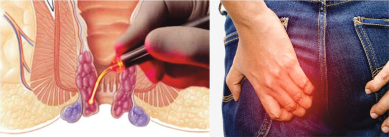 ପାଇଲ୍ସର ଘରୋଇ ଉପଚାର, ମାତ୍ର ୩ ଦିନରେ ମିଳିବ ଆରାମ!