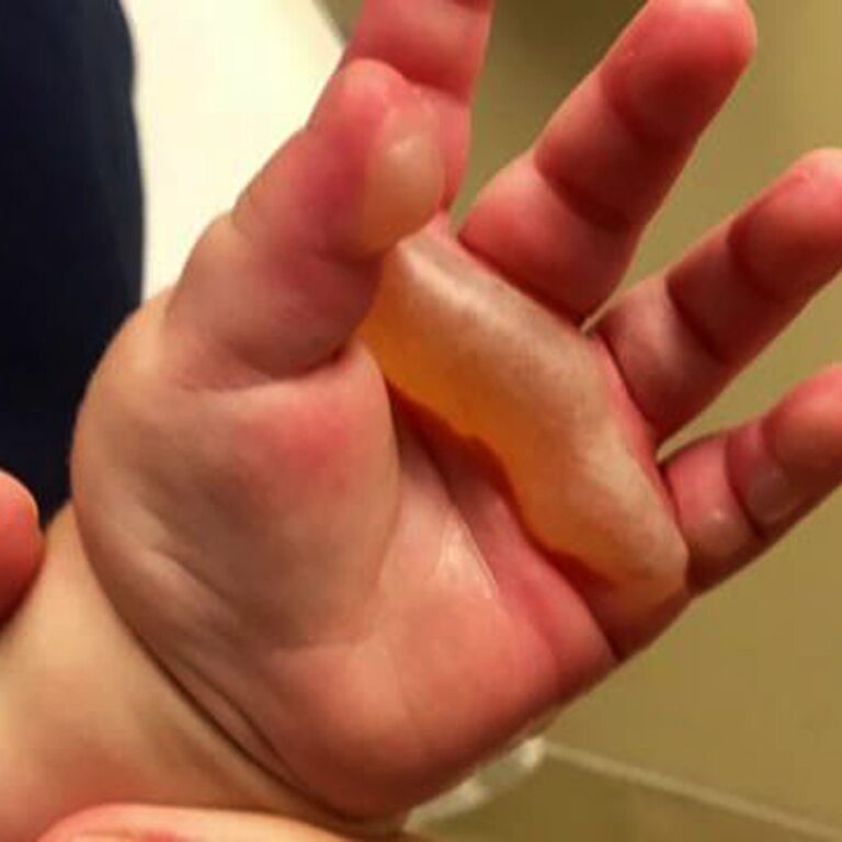 ଯଦି ଆପଣଙ୍କ ପିଲା ଗରମ ପାଣି କିମ୍ବା ଗରମ କ୍ଷୀରରେ ପୋଡ଼ିଯାଏ ତେବେ କଣ କରିବେ?