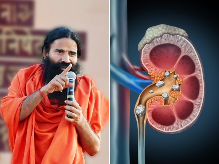 କମ୍ ବୟସରେ ପିଲାଙ୍କୁ ହେଉଛି କିଡନୀ ଷ୍ଟୋନ୍; ବାବା ରାମଦେବ କହିଲେ ବଞ୍ଚିବାର ଉପାୟ